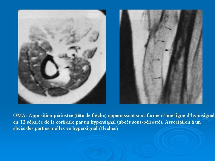 OMA: Apposition périostée (tête de flèche) apparaissant sous forme d’une ligne d’hyposignal en T