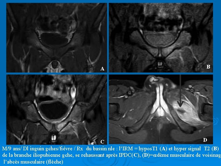 A B D C M/9 ans/ Dl inguin gches/fiévre / Rx du bassin nle
