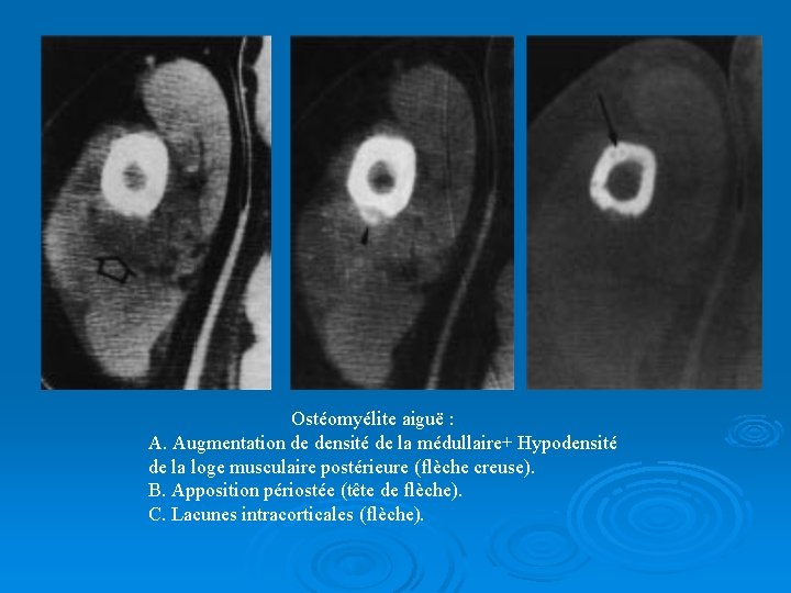 Ostéomyélite aiguë : A. Augmentation de densité de la médullaire+ Hypodensité de la loge