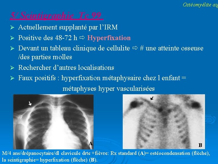 Ostéomyélite aig 5/ Scintigraphie Tc 99 Actuellement supplanté par l’IRM Positive des 48 -72