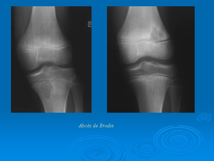 Abcès de Brodie 