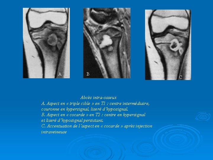 A B Abcès intra-osseux A. Aspect en « triple cible » en T 1