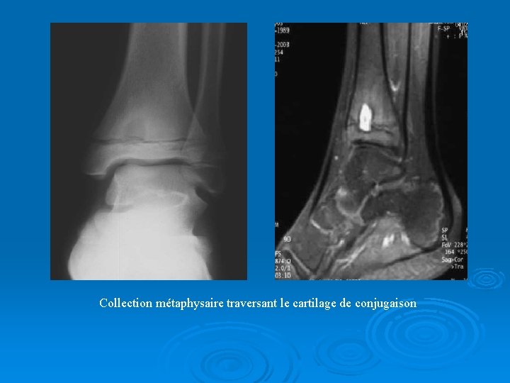 Collection métaphysaire traversant le cartilage de conjugaison 