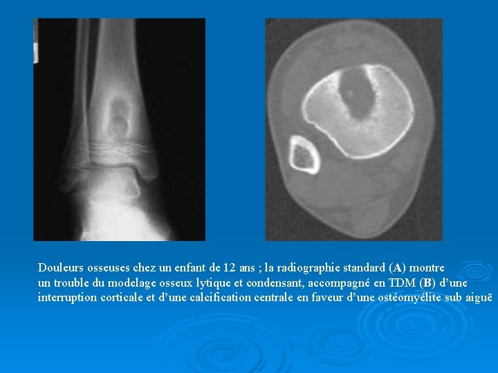 Douleurs osseuses chez un enfant de 12 ans ; la radiographie standard (A) montre