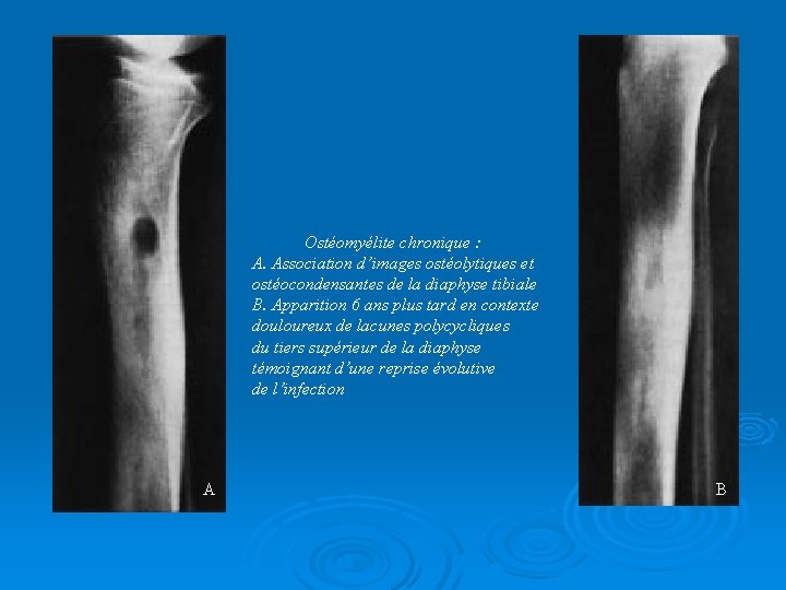 Ostéomyélite chronique : A. Association d’images ostéolytiques et ostéocondensantes de la diaphyse tibiale B.