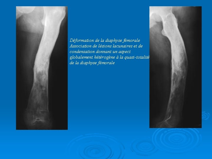 Déformation de la diaphyse fémorale Association de lésions lacunaires et de condensation donnant un