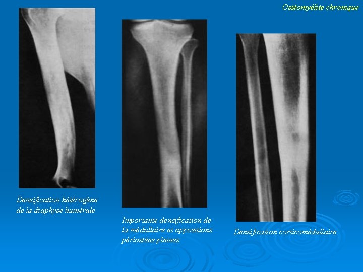 Ostéomyélite chronique Densification hétérogène de la diaphyse humérale Importante densification de la médullaire et