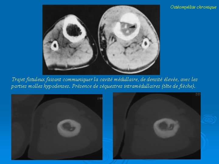 Ostéomyélite chronique Trajet fistuleux faisant communiquer la cavité médullaire, de densité élevée, avec les