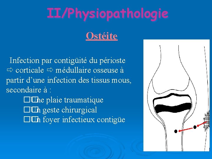 II/Physiopathologie Ostéite Infection par contigüité du périoste corticale médullaire osseuse à partir d’une infection