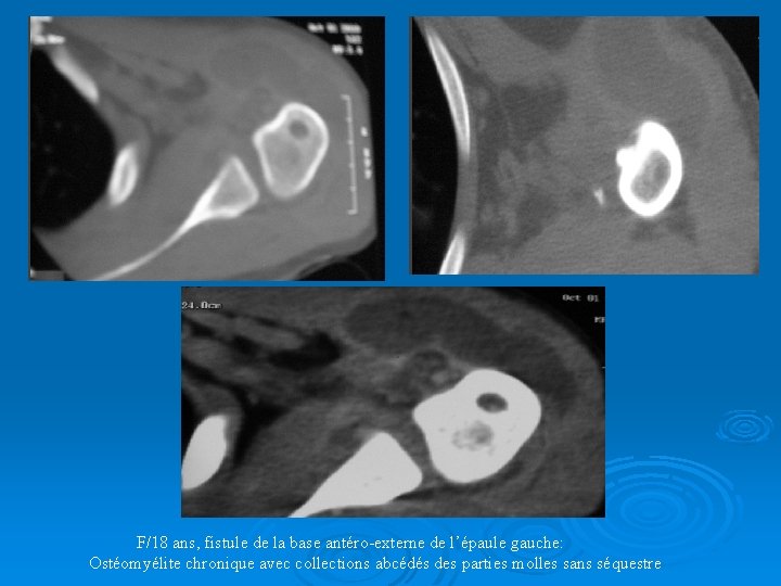 F/18 ans, fistule de la base antéro-externe de l’épaule gauche: Ostéomyélite chronique avec collections