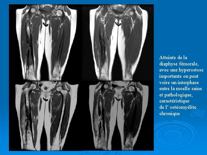 Atteinte de la diaphyse fémorale, avec une hyperostose importante on peut voire un interphase
