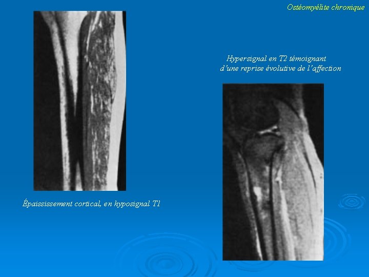 Ostéomyélite chronique Hypersignal en T 2 témoignant d’une reprise évolutive de l’affection Épaississement cortical,