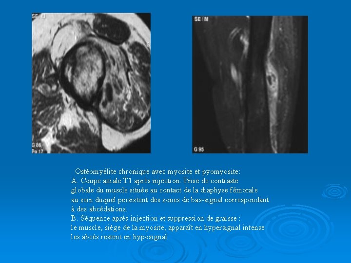 Ostéomyélite chronique avec myosite et pyomyosite: A. Coupe axiale T 1 après injection. Prise