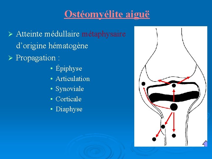 Ostéomyélite aiguë Atteinte médullaire métaphysaire d’origine hématogène Propagation : • • • Épiphyse Articulation