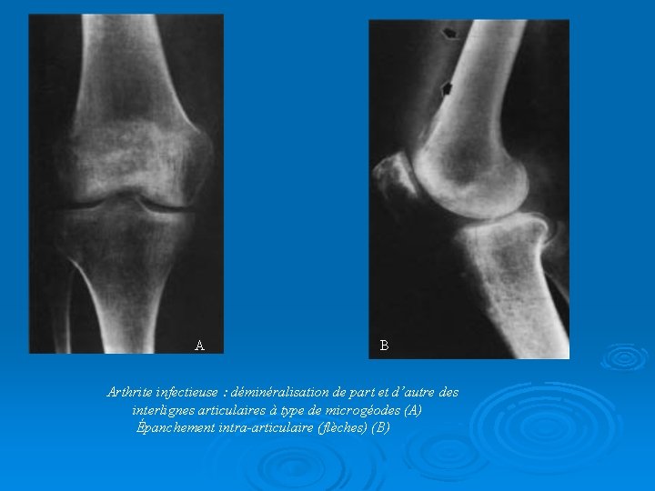 A B Arthrite infectieuse : déminéralisation de part et d’autre des interlignes articulaires à