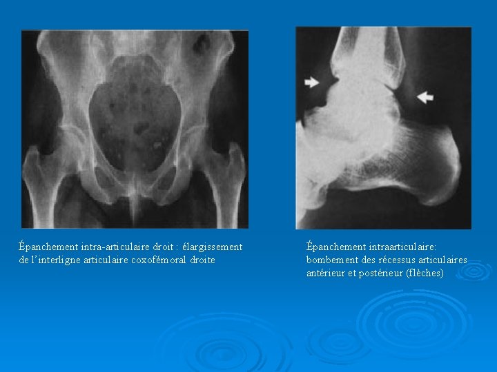 Épanchement intra-articulaire droit : élargissement de l’interligne articulaire coxofémoral droite Épanchement intraarticulaire: bombement des