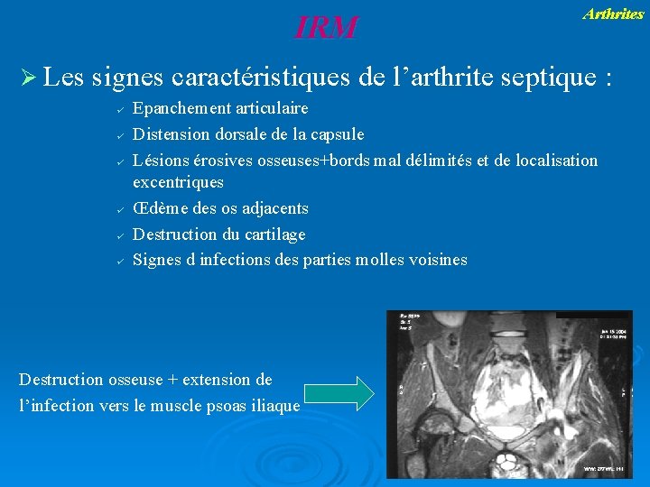 IRM Les Arthrites signes caractéristiques de l’arthrite septique : ü ü ü Epanchement articulaire