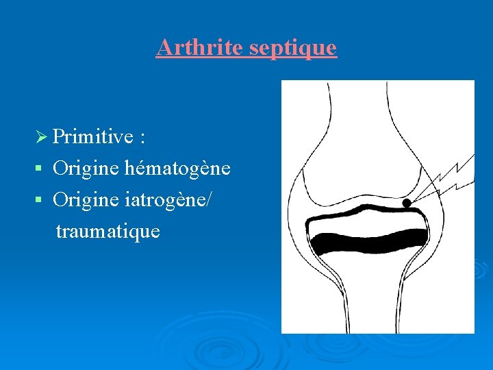 Arthrite septique Primitive : § Origine hématogène § Origine iatrogène/ traumatique 