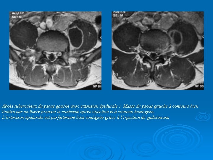 Abcès tuberculeux du psoas gauche avec extension épidurale : Masse du psoas gauche à