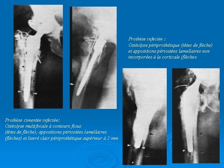 Prothèse infectée : Ostéolyse périprothétique (têtes de flèche) et appositions périostées lamellaires non incorporées