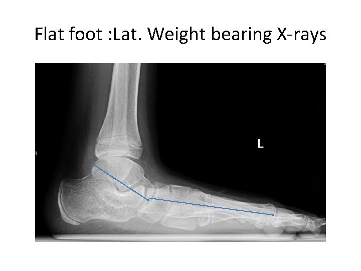 Flat foot : Lat. Weight bearing X-rays 