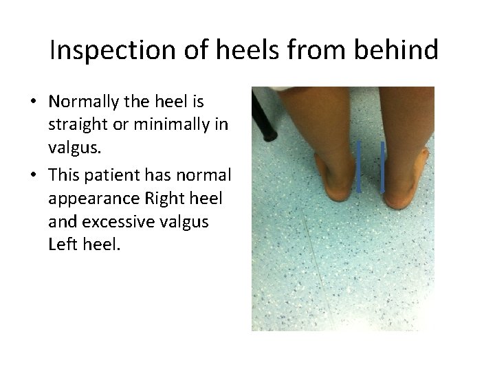 Inspection of heels from behind • Normally the heel is straight or minimally in