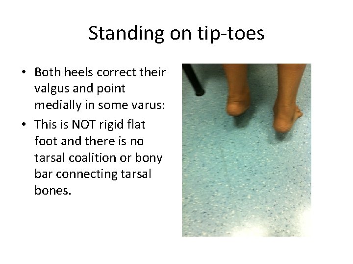 Standing on tip-toes • Both heels correct their valgus and point medially in some