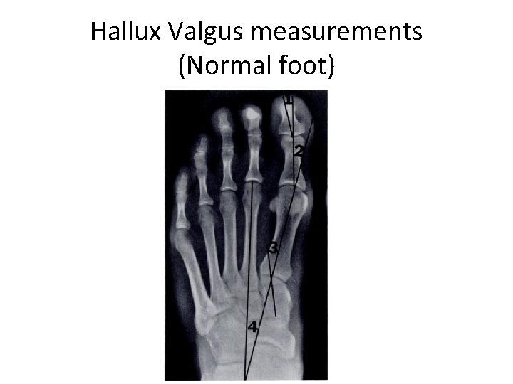 Hallux Valgus measurements (Normal foot) 