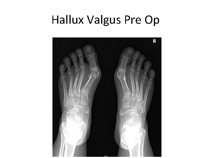 Hallux Valgus Pre Op 