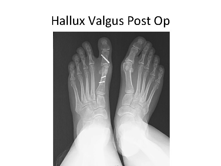 Hallux Valgus Post Op 