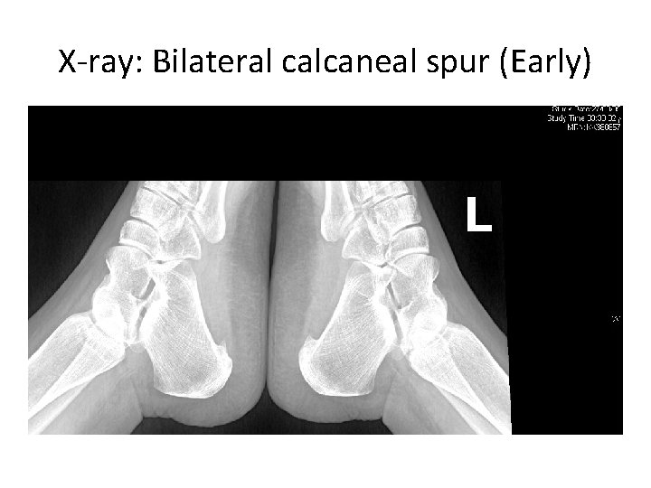 X-ray: Bilateral calcaneal spur (Early) 