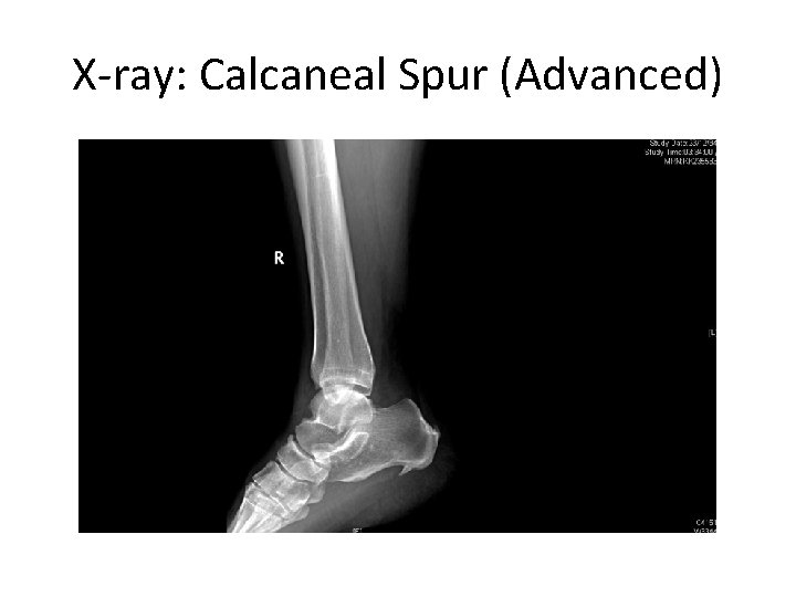 X-ray: Calcaneal Spur (Advanced) 