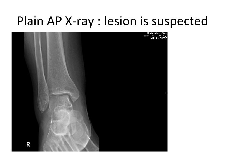 Plain AP X-ray : lesion is suspected 