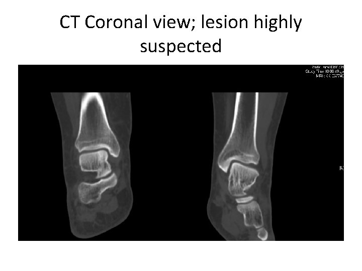 CT Coronal view; lesion highly suspected 