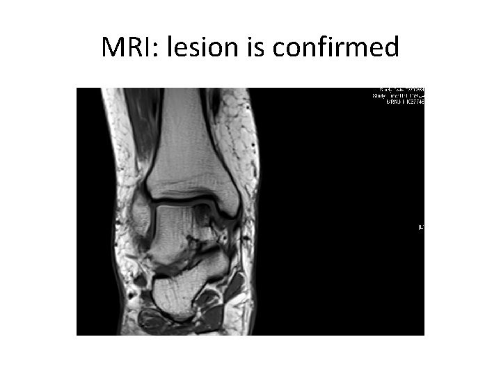 MRI: lesion is confirmed 