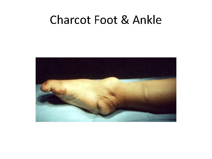 Charcot Foot & Ankle 