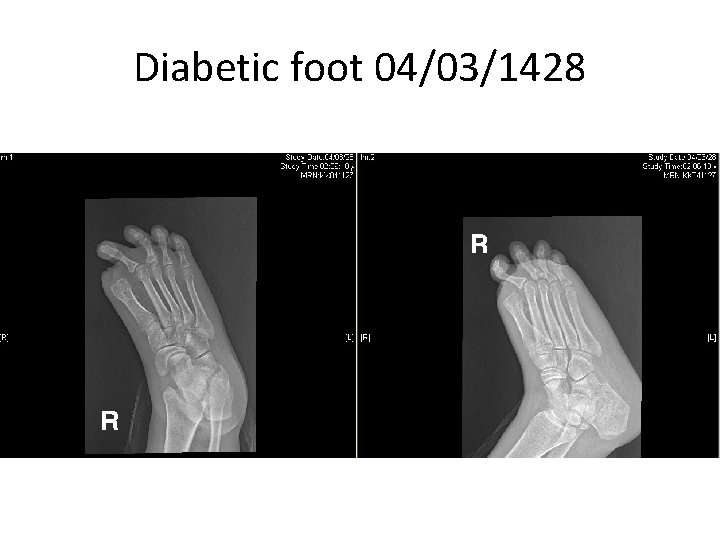 Diabetic foot 04/03/1428 