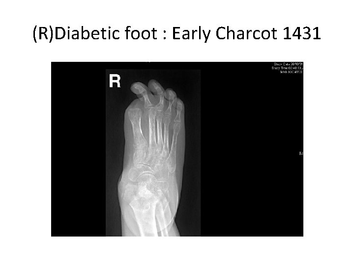 (R)Diabetic foot : Early Charcot 1431 