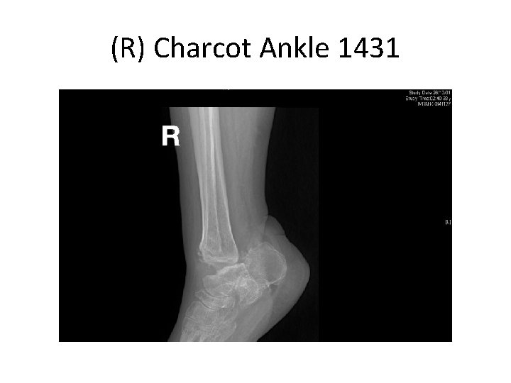 (R) Charcot Ankle 1431 