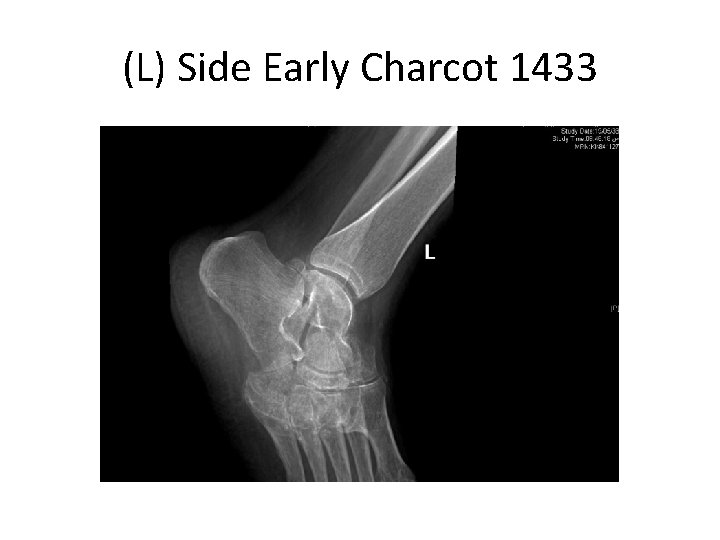 (L) Side Early Charcot 1433 