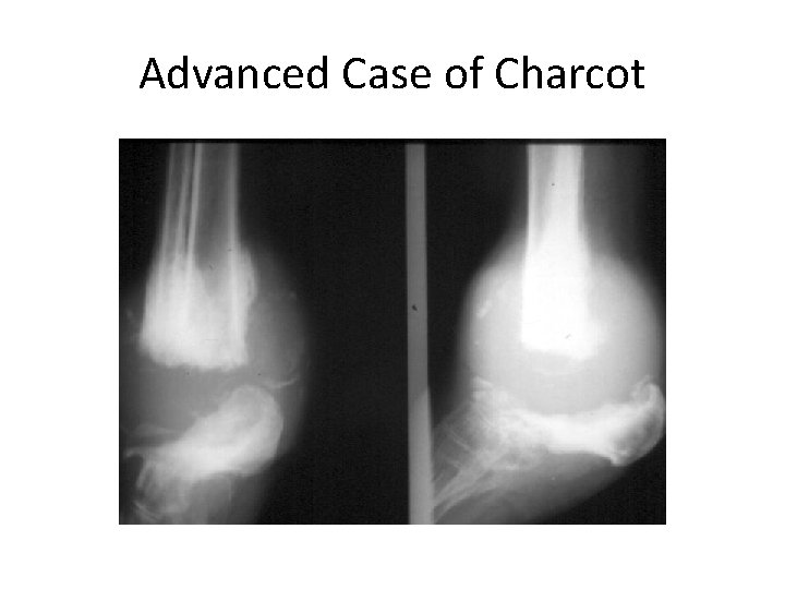 Advanced Case of Charcot 