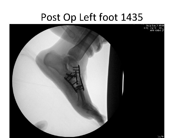 Post Op Left foot 1435 