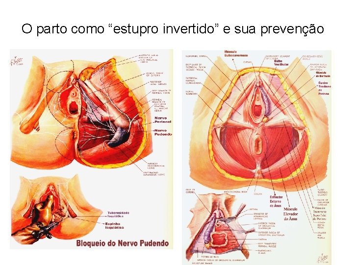 O parto como “estupro invertido” e sua prevenção 