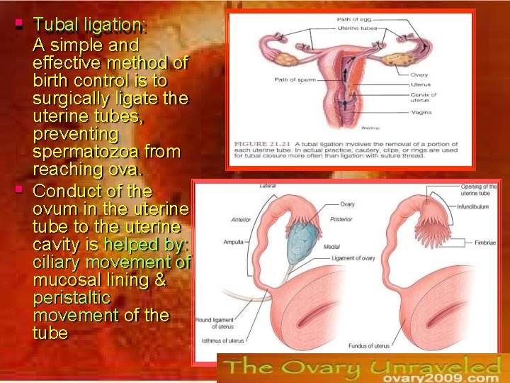  Tubal ligation: A simple and effective method of birth control is to surgically
