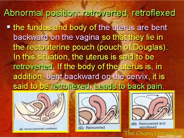 Abnormal position: retroverted, retroflexed the fundus and body of the uterus are bent backward