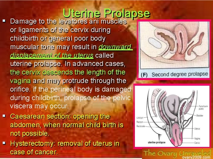 Uterine Prolapse Damage to the levatores ani muscles or ligaments of the cervix during