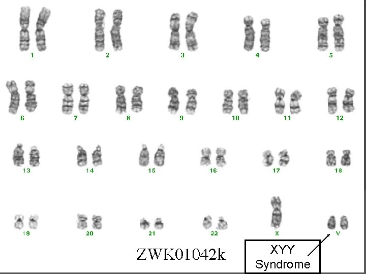 XYY Syndrome 