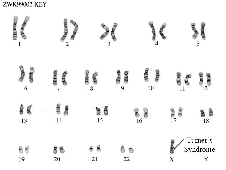 Turner’s Syndrome 