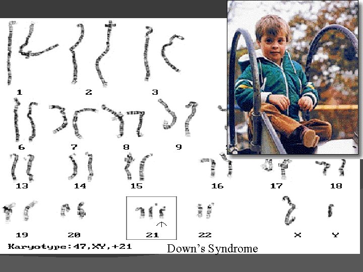 Down’s Syndrome 