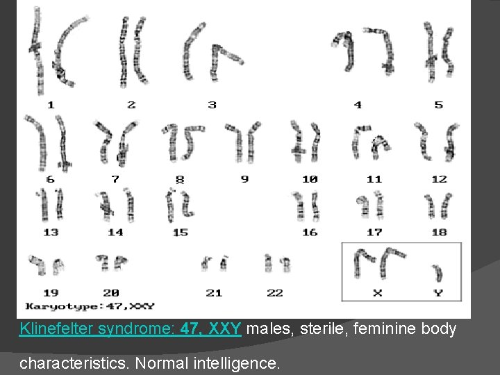 Klinefelter syndrome: 47, XXY males, sterile, feminine body characteristics. Normal intelligence. 